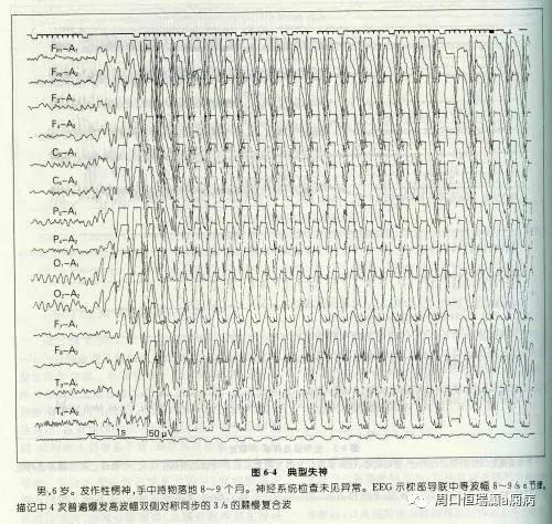 视频脑电图与癫痫