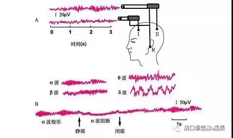 视频脑电图与癫痫