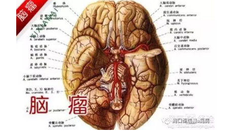 恒瑞王大夫解析其他原因性癫痫