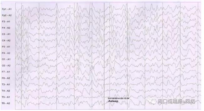 恒瑞癫痫病专科王医生讲解真实病例（1）